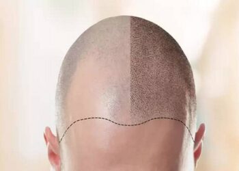 Hair Transplant in Turkey, Best Option You Can Go for