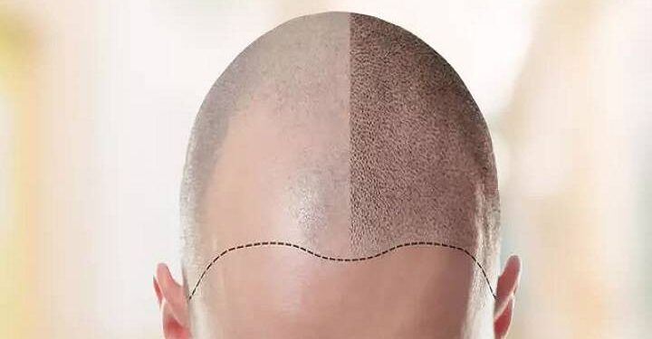 Hair Transplant in Turkey, Best Option You Can Go for