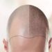 Hair Transplant in Turkey, Best Option You Can Go for